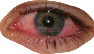 眼睛充血,shot red eye face pink PNG